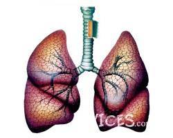 Бронхиальная астма – широко распространенное заболевание. В настоящее время число больных продолжает увеличиваться, несмотря на более раннюю диагностику и современные подходы к лечению