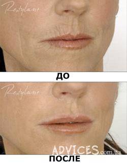 Контурная пластика губ: до и после операции