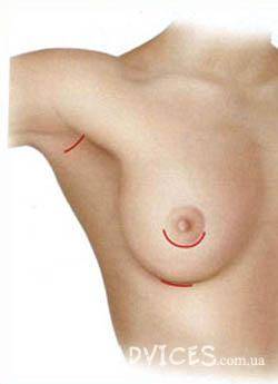 Виды разрезов во время пластической операции по увеличению груди